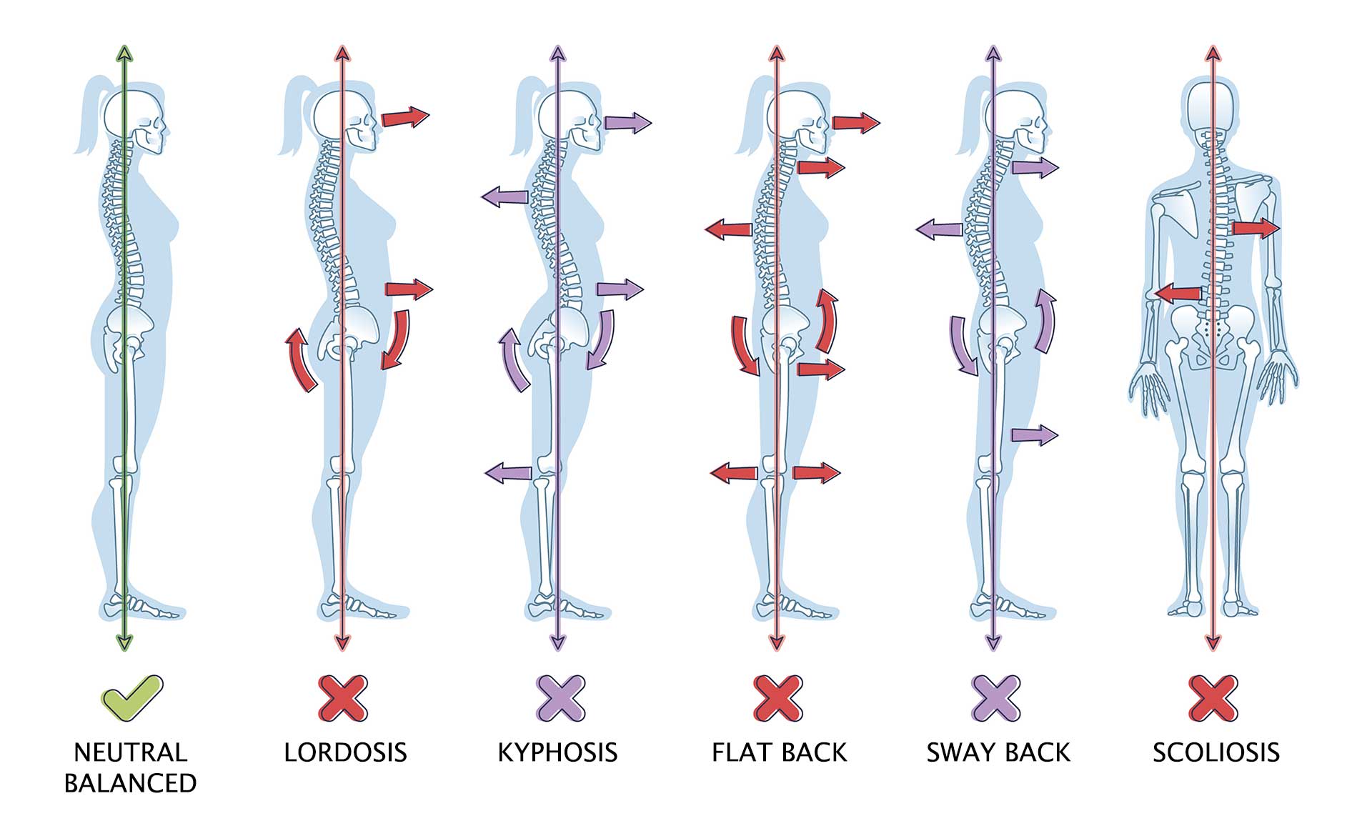 Types of Standing Posture Graphic showing the types of standing posture